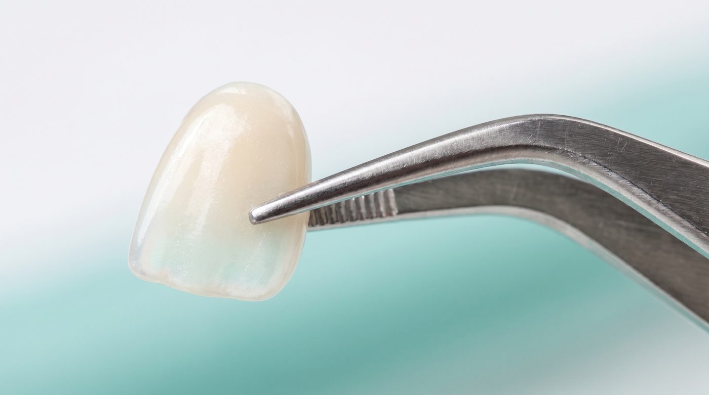Faceta de porcelana dentária sob luz natural com pinças de precisão